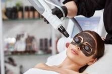 Carbon Peeling (aka Hollywood Facial)