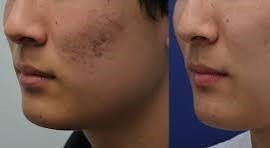 Scar Correction By Micro Needling And RPR