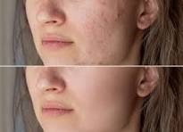 BHAs( Beta Hydroxy Acids)