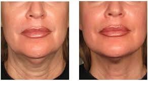 High Intensity Focused Ultrasound (HIFU)